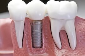 dental-implants-tijuana-mexico dental-implants-tijuana-mexico
