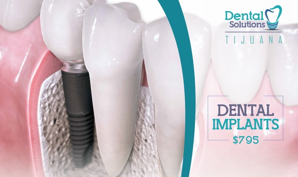 Tijuana Dental Implants - Dental Solutions Tijuana