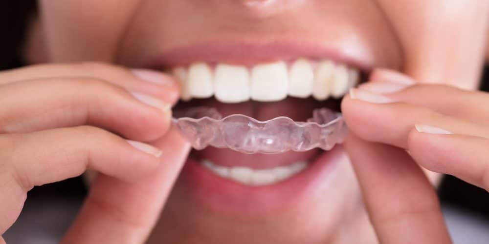 General tips on how to stop bruxism - Dental Solutions Tijuana